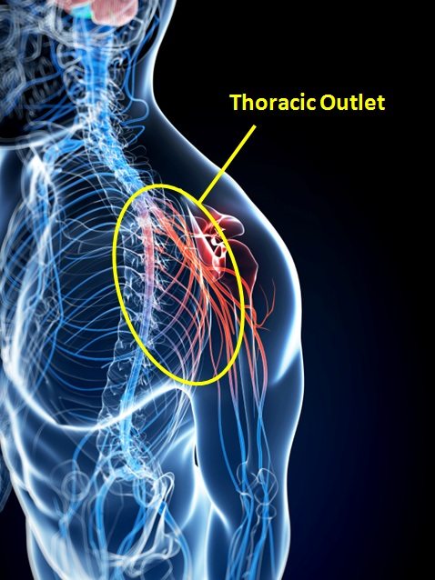 Thoracic-Outlet-Syndrome-TOS